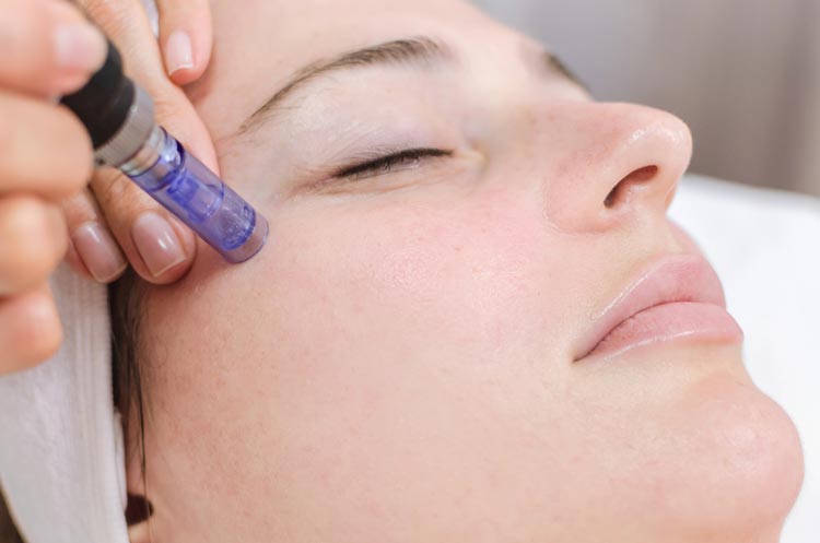 Microneedling terapia cuidado piel