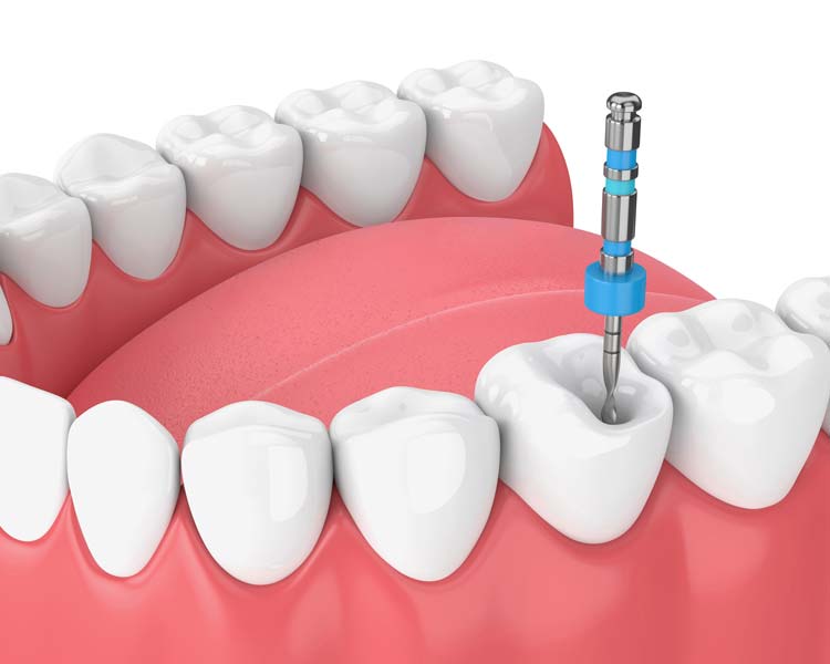 Endodoncia Salud Dental